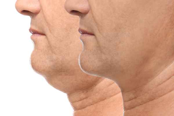 HIFU - Breakthrough in Anti - ageing 2 hifu results Twickenham