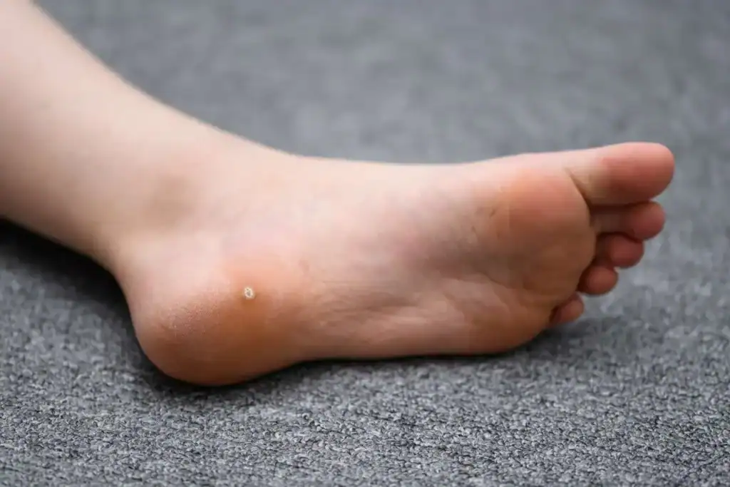 Cryotherapy For Warts And Also Verrucas 2 Image of verruca on the bottom of the foot that able to be treated with Cryotherapy Twickenham
