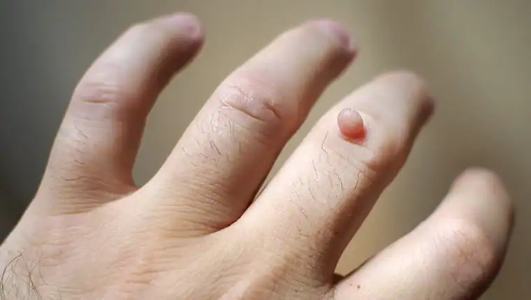 Cryotherapy For Warts And Also Verrucas 1 Image of blemish that Cryotherapy Twickenham can remove with Lipo 360.