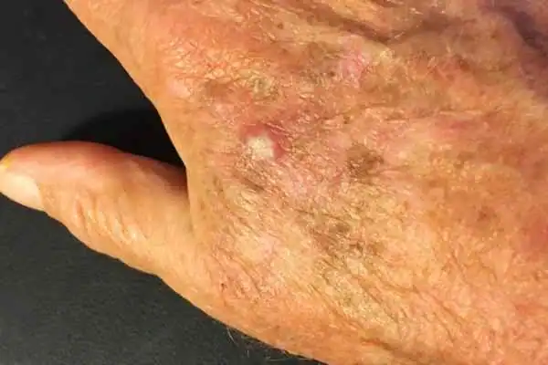 Cryopen For Actinic Keratoses 1 Image of Actinic keratoses Twickenham on a person hand