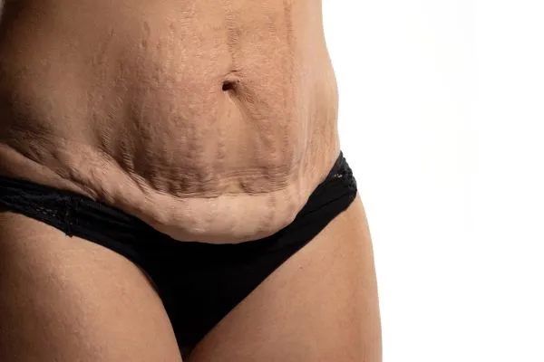 The science behind skin tightening Twickenham picture of a woman's sagging skin on the stomach